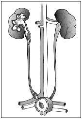 Illustration of kidney stones in kidney, ureter, and bladder.