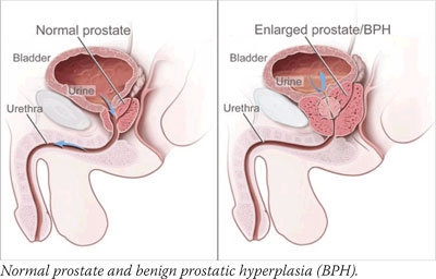 Normal prostate and benign prostatic hyperplasia (BPH).