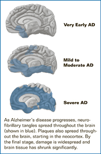 As Alzheimer's disease progresses, neurofibrillary tangles spread throughout the brain (three images show the spread of neurofibrillary tangles throughout the progression). Plaques also spread throughout the brain, starting in the neocortex. By the final stage, damage is widespread and brain tissue has shrunk significantly.