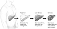 Drawing of the stages of liver damage: normal liver, fatty liver (where deposits of fat cause liver enlargement), liver fibrosis (where scar tissue forms and more liver cell injury occurs), and cirrhosis (where scar tissue makes the liver hard).