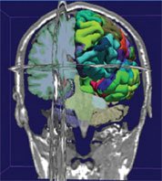 The photograph shows a three-dimensional image of the brain within the skull (coronal view).