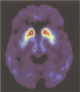 Positron Emission Tomography (PET) images from a Parkinson's patient before fetal tissue transplantation