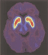 Positron Emission Tomography (PET) images from a Parkinson's patient after fetal tissue transplantation