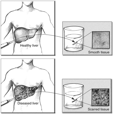 Illustration of a biopsy from a healthy liver and what it looks like under a microscope and an illustration of a biopsy from a diseases liver and what it looks like under a microscope