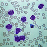Doctors use the drug Gleevec to treat a form of leukemia, a disease in which abnormally high numbers of immune cells
(larger, purple circles in photo) populate the blood.