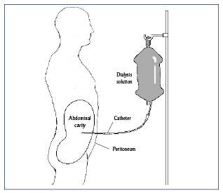 Illustration of a patient having peritoneal dialysis.