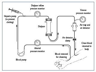 Diagram showing the route blood takes during a hemodialysis treatment.  The patient’s arm is shown in the lower right-hand corner of the diagram.  A needle is inserted into the arm.  Arrows show the direction blood flows from the arm through the tube to the dialyzer and then back to the arm.  Along the circuit, blood passes through an arterial pressure monitor (represented as a circular gauge), a blood pump (represented as a rotating bar with rollers that push the blood through the tube), a heparin pump (to prevent clotting, represented as a syringe), a dialyzer inflow pressure monitor (represented as a circular gauge), the dialyzer (a canister with openings for the inflow and outflow of blood and inflow and outflow of dialysis solution), a venous pressure monitor (represented as a circular gauge), an air trap and air detector (represented as a cylinder around the tube), and an air detector clamp (represented as a circle).  Labels point to each item in the circuit and to where blood is removed from the arm and returned to the arm.