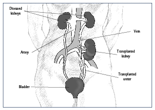 Illustration of a kidney transplantation.
