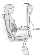 The first step of an exchange is to drain the used dialysis solution from the peritoneal cavity into the drain bag.  Near the end of the drain, you may feel a mild “tugging” sensation that tells you most of your fluid is gone.