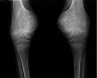 An X-ray showing the characteristic enlargement of the knees in a NOMID patient