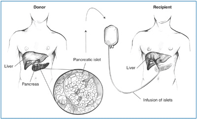 Drawing of two body torsos showing the infusion of islets extracted from a donor pancreas into a transplant recipient.