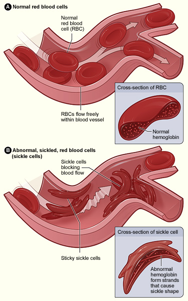 Figure A shows normal red blood cells flowing freely in a blood vessel. The inset image shows a cross-section of a normal red blood cell with normal hemoglobin. Figure B shows abnormal, sickled red blood cells clumping and blocking blood flow in a blood vessel. (Other cells also may play a role in this clumping process.) The inset image shows a cross-section of a sickle cell with abnormal hemoglobin.