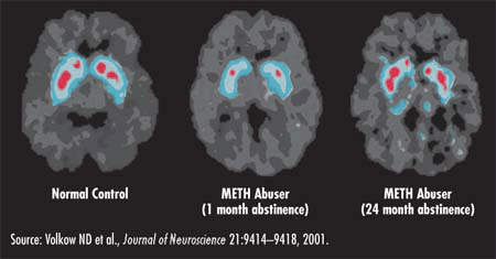 Recovery of Brain Dopamine Transporters
in Chronic Methamphetamine (METH) Abusersin Chronic Methamphetamine (METH) Abusers