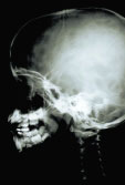 X-ray of kid's skull