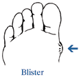 Drawing of a foot with an arrow pointing to a blister.