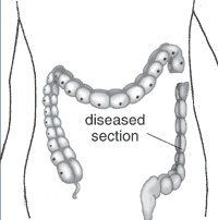 Large intestine with diseased section.