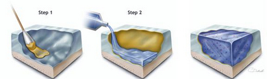 Image depicting the two-step process of first applying the CS adhesive and then applying the cell-enriched hydrogel