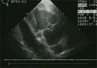Preoperative long axis view of mitral valve with prolapsing leaflet.