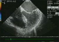 Preoperative Doppler demonstrating significant mitral regurgitation as a result of the prolapse.