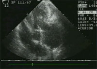 Postoperative long axis view demonstrating coaptation of leaflets and repair of prolapse.