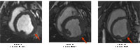 Cine MRI Images: MRI images from animals with coronary occlusions treated with CO2 TMR that demonstrate an improvement in function for Group 1 and 2 (arrow identifies treated area) but a decrease in function when more channels are created (Group 3).