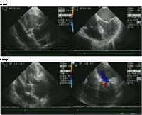 Preoperative (top panel) echocardiography images from a patient with severe mitral valve regurgitation. After the valve is repaired (lower panel) the mitral valve no longer leaks.