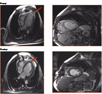 Preoperative (top panel) MR images from a patient that had suffered a myocardial infarction and had loss of heart muscle and function. Not only was a significant focal area damaged and thinned (arrow), but the overall contractility was diminished. Restoration of normal heart shape following a surgical resection of the damage muscle (arrow) leads to improved heart function.