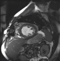 Postoperative short axis view of smaller more dynamic ventricle after reconstruction.