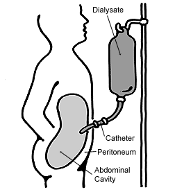 Illustration of a person being treated with peritoneal dialysis