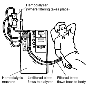 Illustration of a man being treated with hemodialysis.