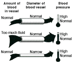 Diagram of three blood vessels. The top drawing shows a normal amount of blood in a vessel of normal diameter, resulting in normal blood pressure. The middle drawing shows too much blood in a vessel of normal diameter, resulting in high blood pressure.
