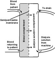 Illustration of a dialyzer