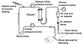 Illustration of hemodialysis machine