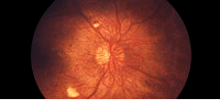 Diabetic Eye