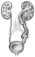 Drawing of a urinary tract with hydroureter and hydronephrosis on one side.