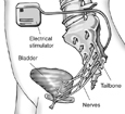Drawing of an electrical stimulator for bladder nerves, an implanted device that delivers mild electrical pulses to the nerves that control bladder function.