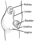 Side view diagram of the female urinary tract. Labels point to the kidney, ureter, bladder, urethra, and vagina.The organs appear within the outline of a young female shown from the abdomen to the thigh.