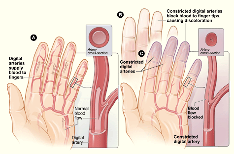 Illustration of how Raynaud's affects the fingers