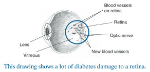 Picture of eye showing a lot of diabetes damage.