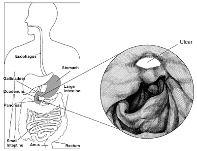 Illustration of the digestive tract highlighting the stomach, and the duodenum, with a close-up of a ulcer.