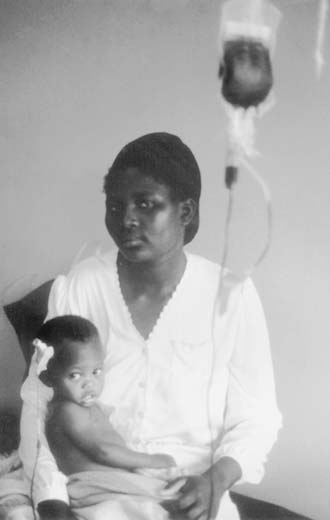 Photo of a child who is being transfused through a vein on his head to treat severe anemia caused by malaria