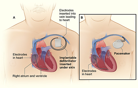 Cardioverter Defibrillator and a Pacemaker