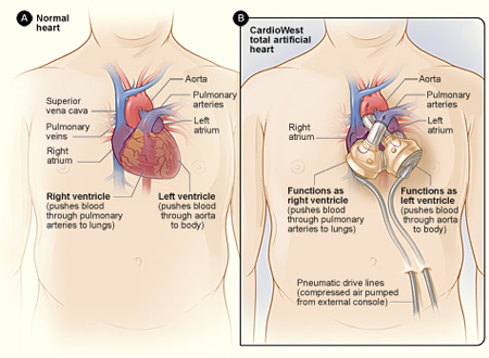 Figure A shows the normal anatomy and location of the heart. Figure B shows a CardioWest TAH. Tubes exit the body and connect to a machine that powers and controls how the CardioWest TAH works.