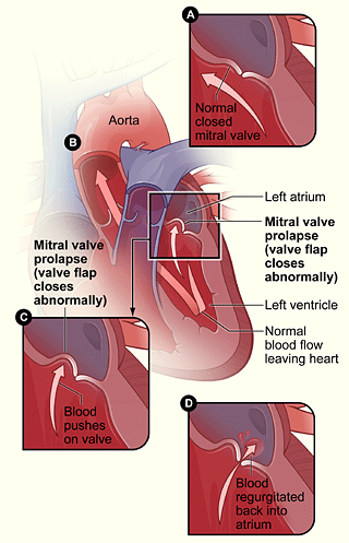 Figure A shows the normal mitral valve separating the left atrium from the left ventricle. Figure B shows the heart with mitral valve prolapse. Figure C shows the detail of mitral valve prolapse. Figure D shows a mitral valve that allows blood to flow backward into the left atrium.