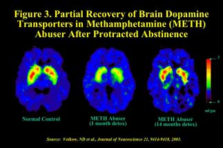 brain scans showing partial recovery in brain activity   in methamphetamine abusers after protrected abstinence - in text