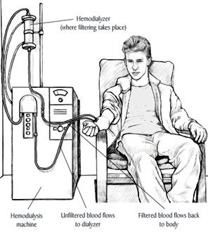 Illustration of teenage boy receiving hemodialysis. The boy is sitting in a chair next to the hemodialysis machine with two tubes attached to his arm. Unfiltered blood flows from the boy's arm to the hemodialyzer (where filtering takes place). Then filtered blood flows from the hemodialyzer back to the boy's body.