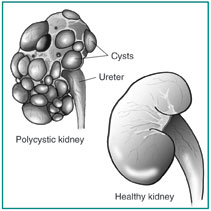 Diagram of two kidneys.  The healthy kidney on the lower right is smooth.  The polycystic kidney on the upper left has many fluid-filled sacs on the surface.  Labels point to the ureter and cysts on the polycystic kidney.