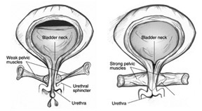 Diagram of two bladders, one with weak pelvic muscles and one with strong pelvic muscles.  The bladder on the left has weak pelvic muscles that fail to keep the urethra closed, so urine escapes.  Labels point to the bladder neck, weak pelvic muscles, urethral sphincter, and urethra.  The bladder on the right has strong pelvic muscles that keep the urethra closed, so no urine can escape.  Labels point to the bladder neck, strong pelvic muscles, and urethra.