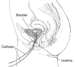 Illustration showing a catheter inserted into the bladder.