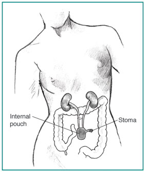Anatomic drawing of female torso with internal pouch for continent urinary diversion.  The large intestine is shown in outline.  The kidneys, ureters, and internal pouch are displayed in more detail.  The ureters descend from the kidneys to the internal pouch, which has been formed from a piece of the stomach or intestine.  A tube from the pouch extends beyond the skin surface to form a stoma.